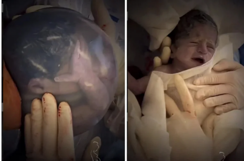&lt;p&gt;Nevjerojatan prizor bebe rođene u vodenjaku&lt;/p&gt;
