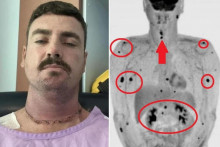 &lt;p&gt;Selfie nakon operacije i snimka PET CT-a koja pokazuje da su metastaze zahvatile cijelo tijelo&lt;/p&gt;
